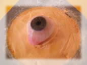 Kyveta se syntetickou oční protézou