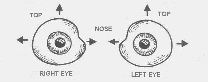 INSERTING AND REMOVING THE ARTIFICIAL EYE